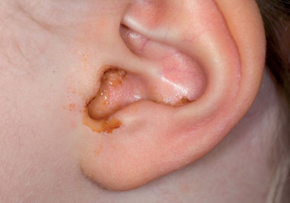 Đau tai trái có thể là do viêm tai giữa, viêm tai ngoài