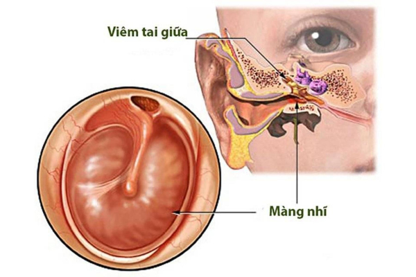 Màng nhĩ là bộ phần nằm giữa tai ngoài và tai giữa