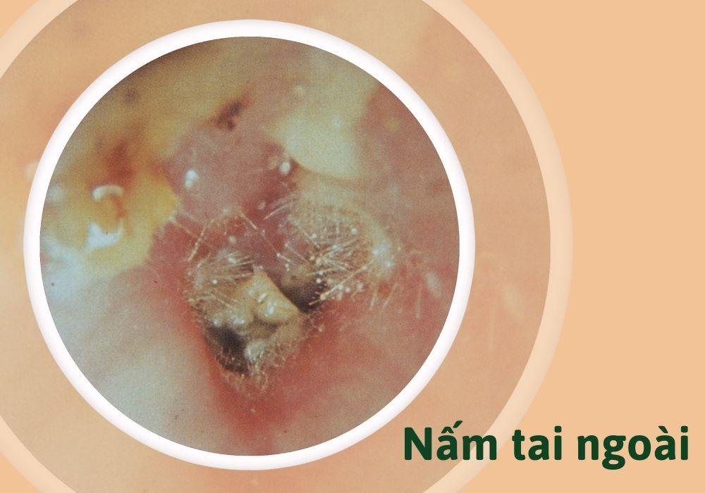 Nấm tai ngoài là tình trạng nhiễm trùng tai do nấm