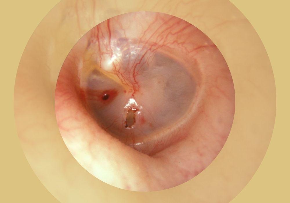 Thủng màng nhĩ là biến chứng thường gặp của nấm ống tai