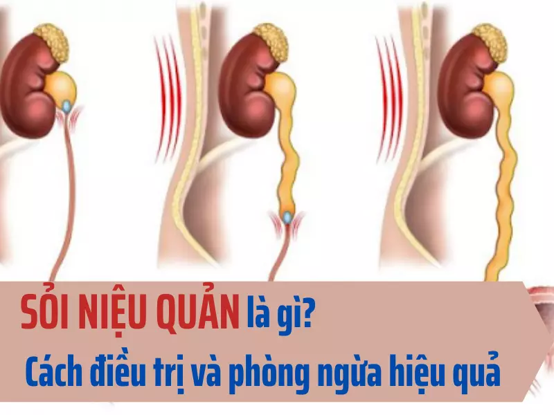 Sỏi niệu quản là gì? Cách điều trị và phòng ngừa hiệu quả