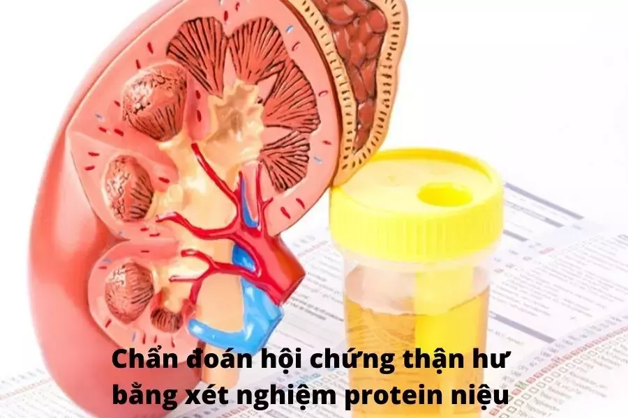 Protein-nieu-la-mot-trong-nhung-tieu-chuan-xac-dinh-hoi-chung-than-hu.webp