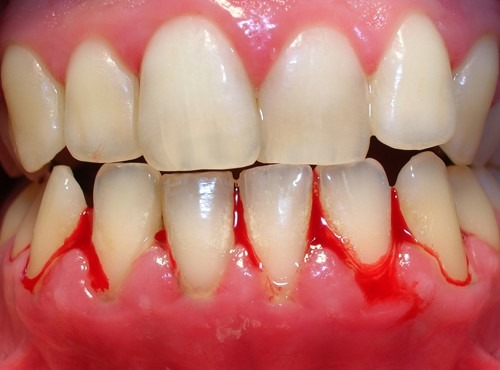 Chảy máu chân răng cảnh báo bệnh răng miệng – Cách điều trị