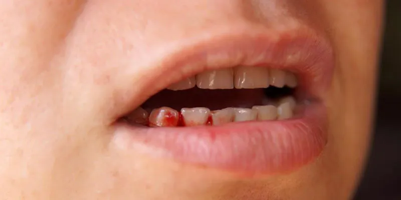 Cần xử lý như thế nào khi bị viêm lợi, chảy máu chân răng?