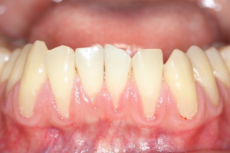 Tụt lợi có thể gây ra mất răng – Cách điều trị hiệu quả nhất