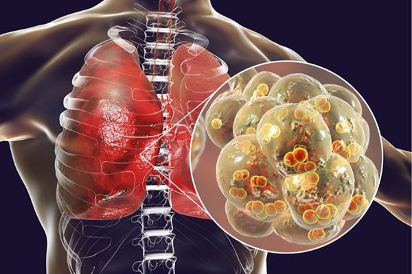 Biến chứng viêm phổi do viêm thanh quản cấp rất nguy hiểm