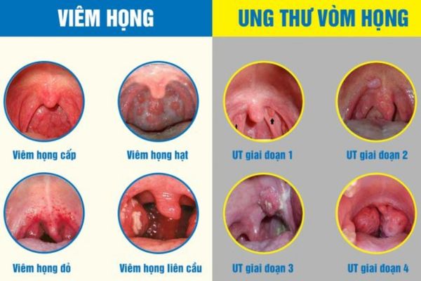 Viêm họng thường gây ra khản tiếng và nhiều biến chứng khác