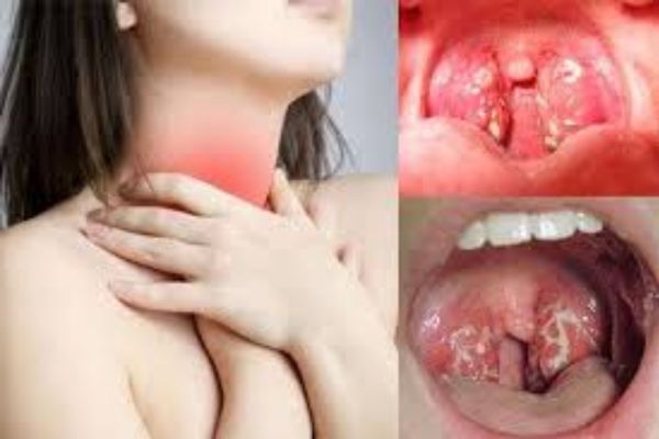 Đau rát cổ họng là triệu chứng của viêm amidan