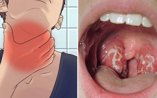 Viêm họng giả mạc (viêm họng bạch cầu) rất nguy hiểm