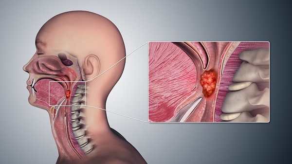 Viêm họng hạt có thể biến chứng sang ung thư vòm họng