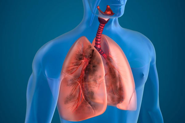 Viêm phổi mạn tính gây ảnh hưởng đến sức khỏe và cuộc sống sinh hoạt