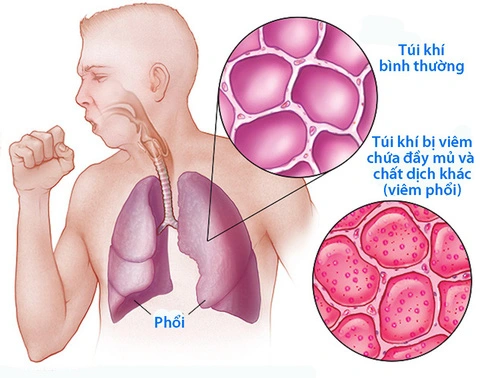 Viêm phổi nặng ở người lớn: Dấu hiệu cảnh báo