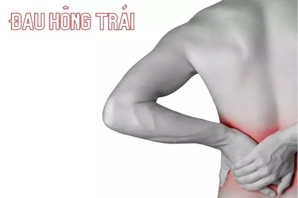 Nguyên nhân đau hông trái và cách giảm đau hiệu quả tại nhà
