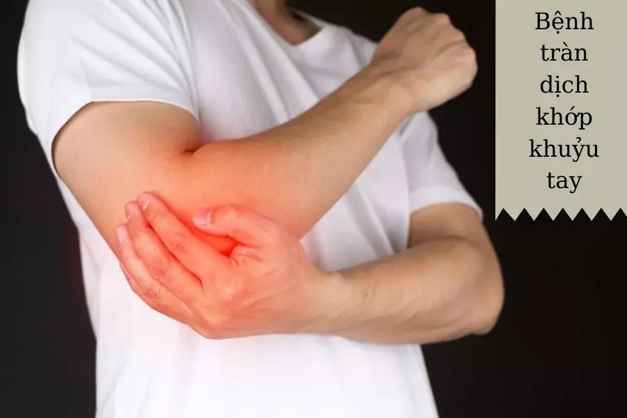 Bệnh tràn dịch khớp khuỷu tay có thể gặp ở mọi đối tượng