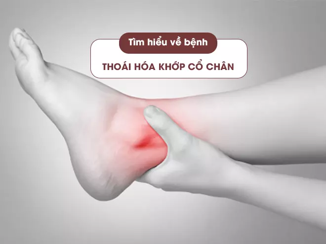 Bệnh thoái hóa khớp cổ chân – Thông tin hữu ích cho bạn!