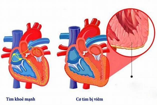Viêm tim là một biểu hiện nặng của bệnh thấp tim