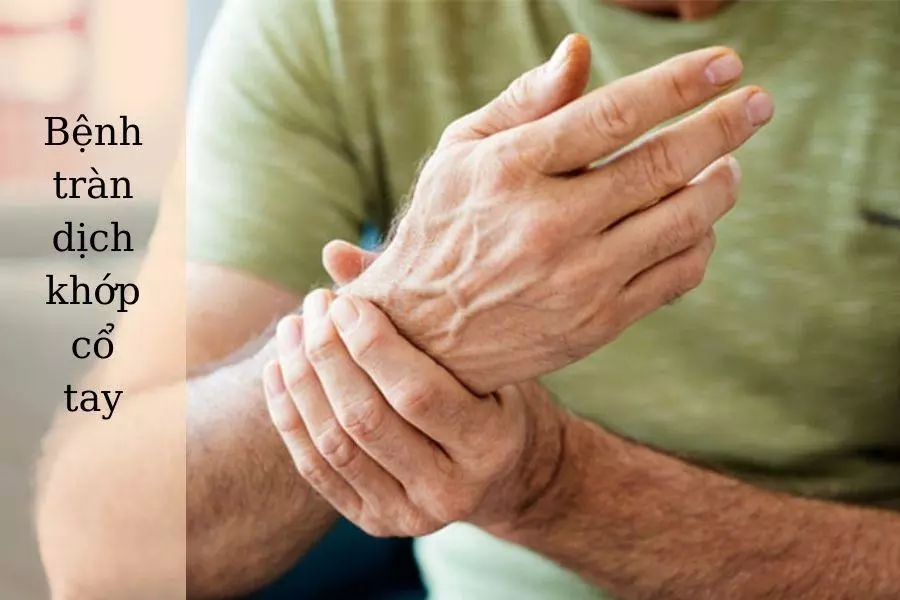Tràn dịch khớp cổ tay là gì? Triệu chứng và cách điều trị