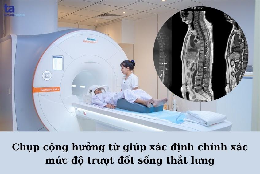Chụp cộng hưởng từ MRI giúp xác định mức độ chèn ép rễ thần kinh do trượt đốt sống thắt lưng