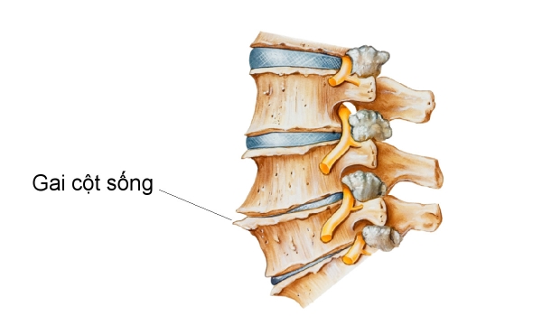 Gai cột sống chèn ép rễ thần kinh thắt lưng gây đau nhức khó chịu