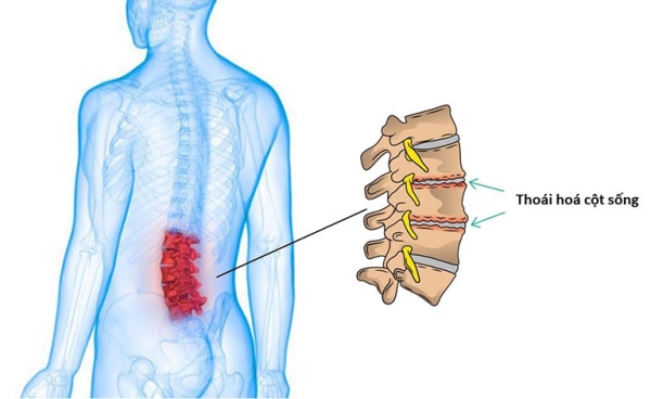 Thoái hóa cột sống có thể gây đau nhức rễ thần kinh thắt lưng