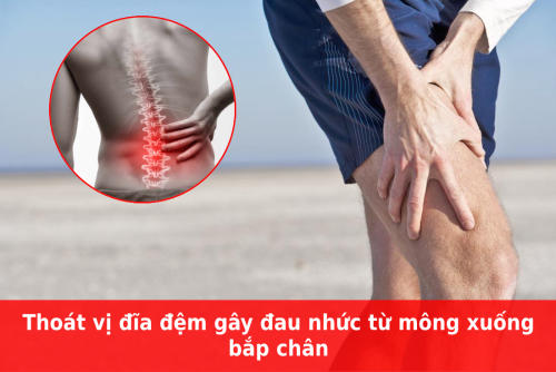 Thoát vị đĩa đệm chèn ép lên dây thần kinh là nguyên nhân hàng đầu gây đau từ mông xuống bắp chân