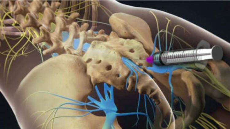 Tiêm ngoài màng cứng corticosteroid vào dây thần kinh cột sống hoặc ống tủy sống mang lại hiệu quả khác nhau ở mỗi người