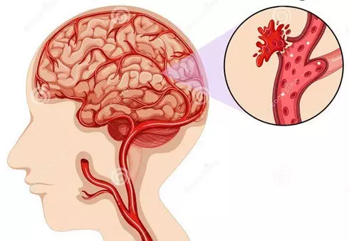 Người bị đột quỵ do đứt mạch máu não có nguy cơ tử vong cao