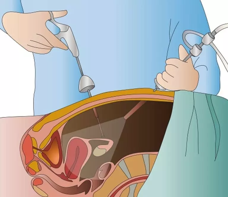Hình ảnh phẫu thuật u xơ tử cung