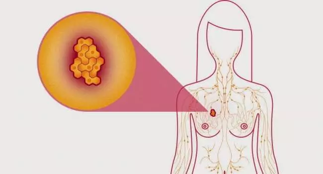 Nang tuyến vú thường gặp ở phụ nữ tiền mãn kinh