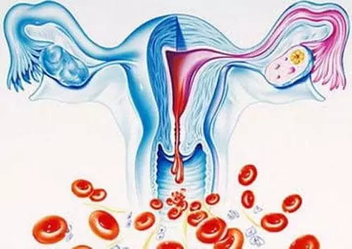 U xơ tử cung có thể gây rong kinh kéo dài