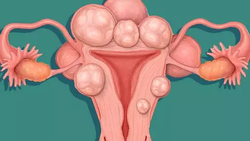 U xơ tử cung là bệnh phụ khoa phổ biến ở phụ nữ trong độ tuổi sinh sản