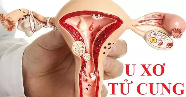 U xơ tử cung chiếm toàn bộ tử cung và dễ gây vỡ