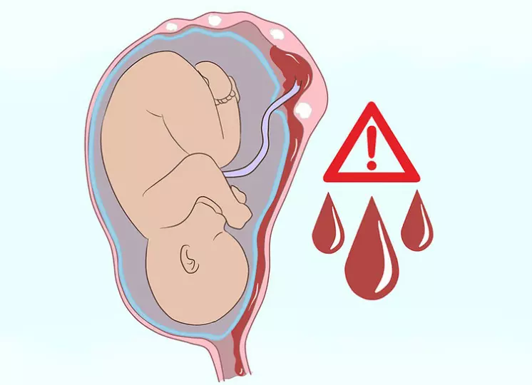 Băng huyết và sót nhau khi có u xơ tử cung lúc thai kì