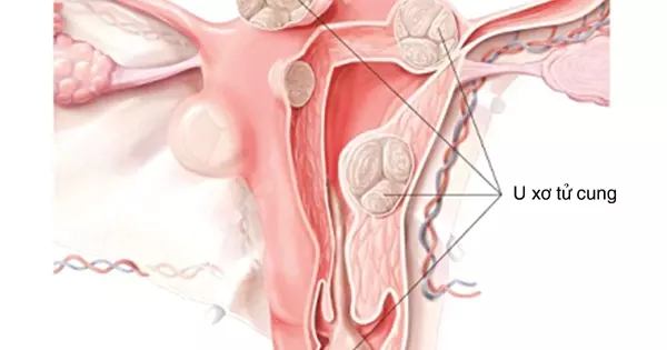 Điều trị u xơ tử cung bằng morcellator gây ra nhiều biến chứng nghiêm trọng