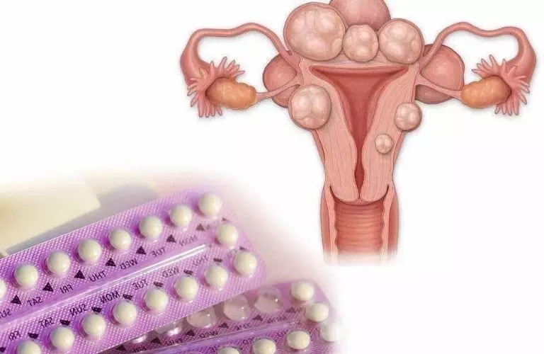 Thuốc tránh thai có thể cải thiện bệnh u xơ tử cung