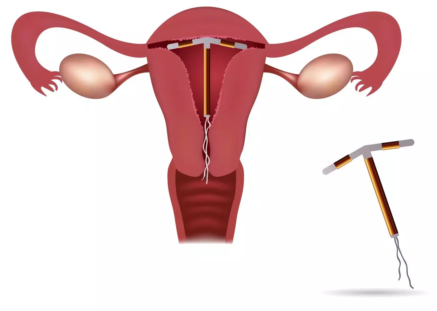 Tránh thai cho phụ nữ bị u xơ tử cung bằng phương pháp đặt vòng
