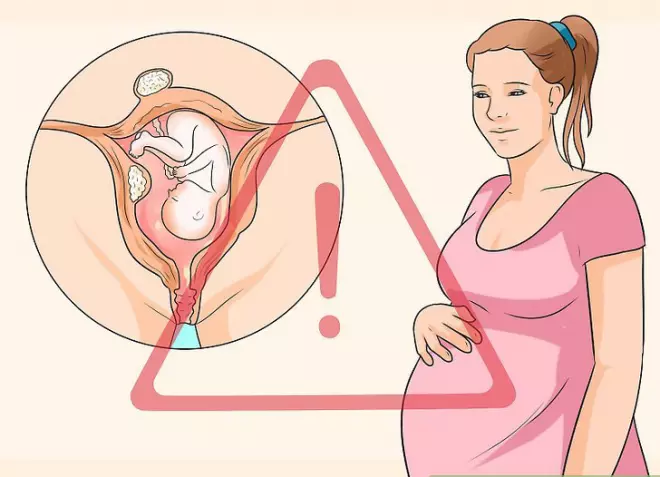 U xơ tử cung làm ảnh hưởng đến quá trình mang thai và sinh đẻ của phụ nữ