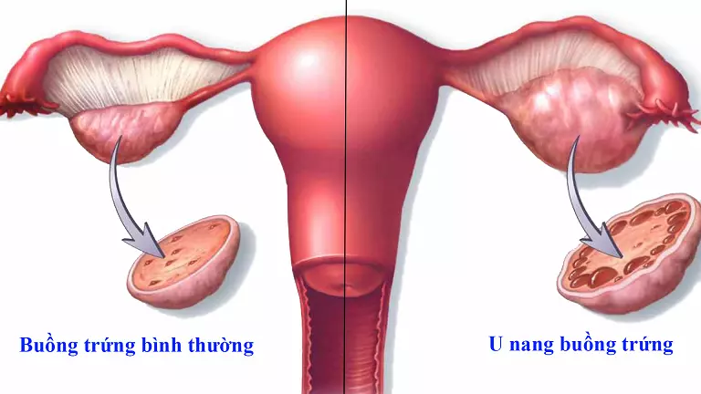 Ngăn ngừa biến chứng do u nang buồng trứng