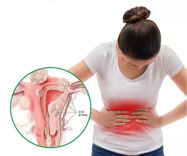 U xơ tử cung là một trong những nguyên nhân gây đau bụng, rong kinh 