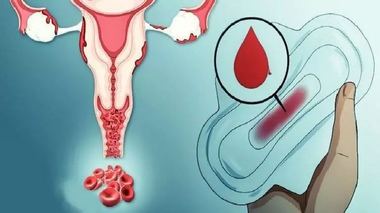 Rong kinh – Triệu chứng bệnh u xơ tử cung