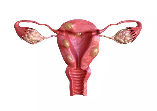 50% phụ nữ bị u xơ tử cung không có triệu chứng