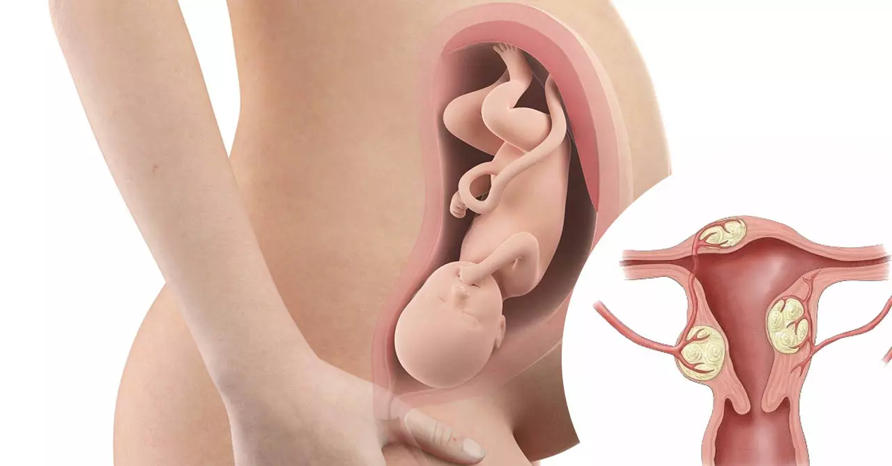 U xơ tử cung tăng kích thước khi mang thai