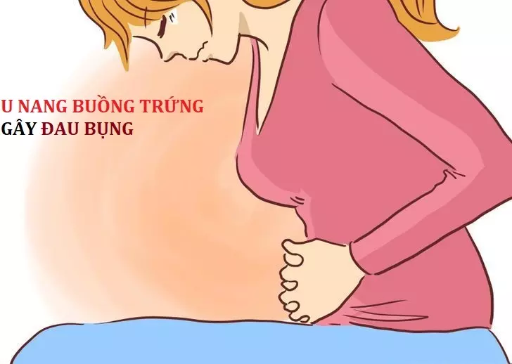 U nang buồng trứng gây đau bụng. Tại sao?