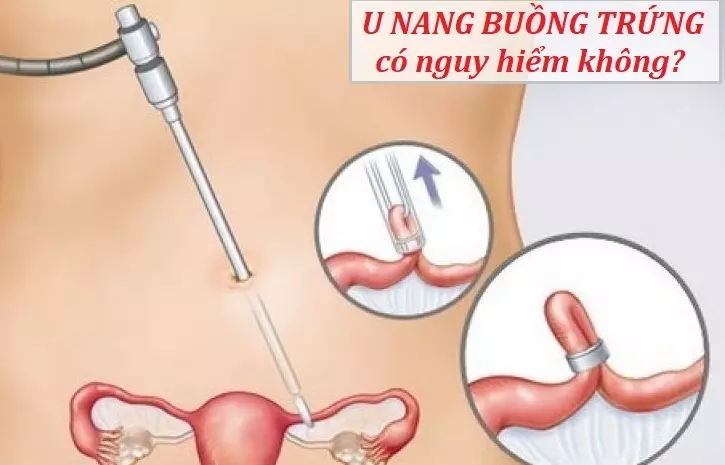 Bệnh u nang buồng trứng có nguy hiểm không?