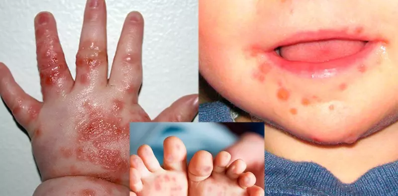 Trẻ mắc bệnh tay chân miệng có thể gặp một số biến chứng nguy hiểm