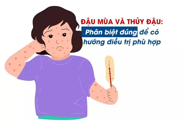 Đậu mùa và thủy đậu: Phân biệt đúng để có hướng điều trị phù hợp