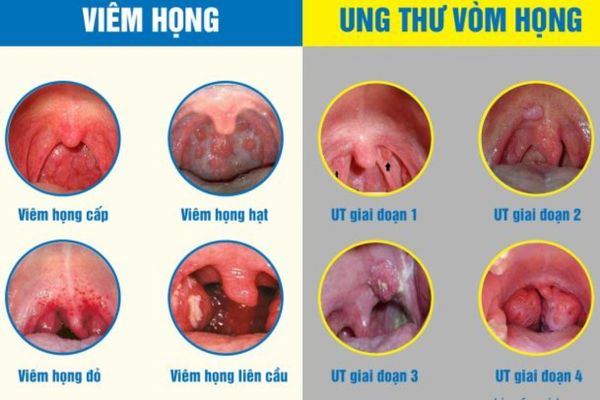 Các dạng viêm họng và giai đoạn tiến triển ung thư vòm họng