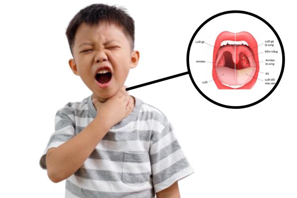 Viêm amidan ở trẻ là một trong những bệnh đường hô hấp phổ biến
