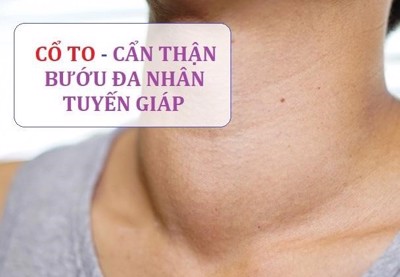  Cổ tự nhiên to – cẩn thận bướu đa nhân tuyến giáp! 