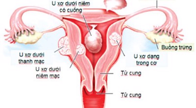 Phát hiện và điều trị u xơ tử cung